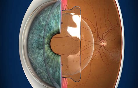 Everything you need to know about ICL Phakic Surgery | Nidhi Eye and Multispeciality Hospital in ...