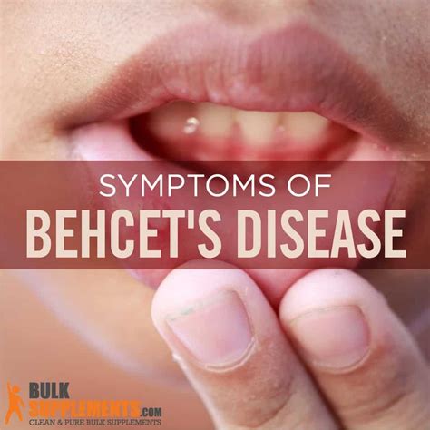 Behcet's Disease: Symptoms, Causes & Treatment