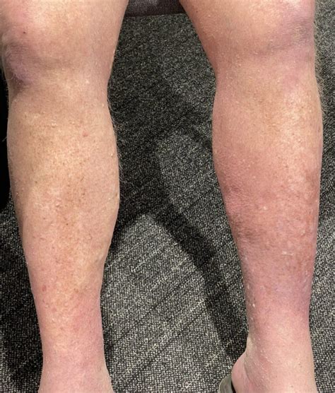 Unilateral Leg Swelling: Chronic Venous stasis vs Lymphedema