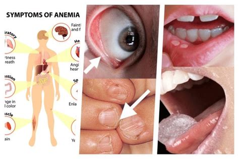 Start eating more iron right away if you experience any of these 10 signs of anemia