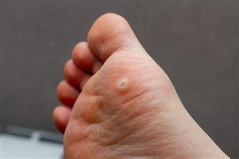 Plantar wart removal: How to remove plantar warts correctly – Arizona Foot Doctors