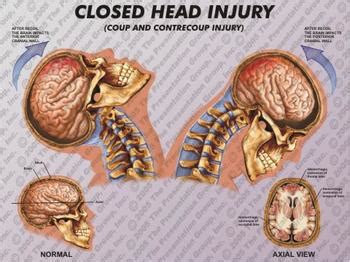 Head Injury: Symptoms Of Closed Head Injury