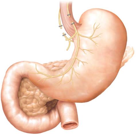 Truncal Vagotomy and Pyloroplasty | Abdominal Key