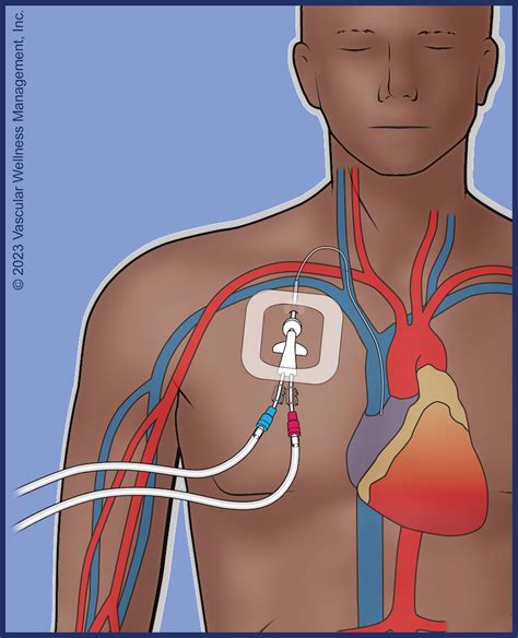 Tunneled Central Lines | Vascular Wellness