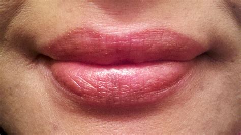 eczema on lip - pictures, photos