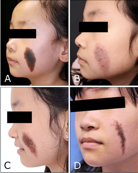 Congenital Melanocytic Nevus Removal