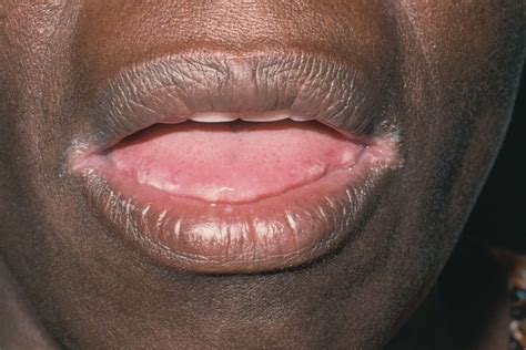 Angular Cheilitis: Symptoms, Causes, Risk Factors, and More