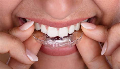 Everything You Need To Know About Removable Braces - TheWellthieone