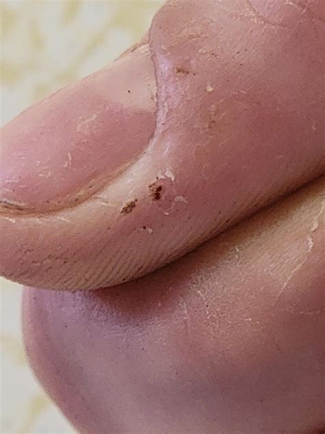 Do these look like periungual warts? : r/Warts