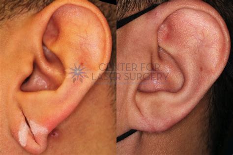 Earlobe Repair | Washington, DC | Center for Laser Surgery