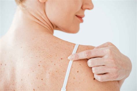 Difference Between a Mole Removal And a Biopsy | Click Here!