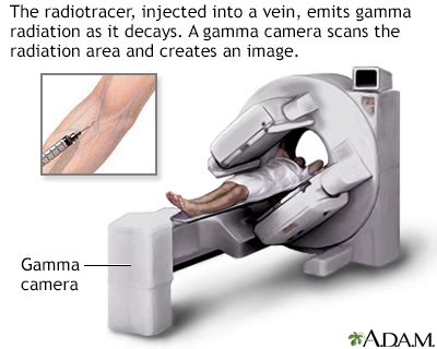 Nuclear stress test Information | Mount Sinai - New York