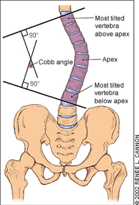 File:Cobb angle (Greiner, 2002).png - Physiopedia