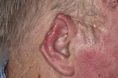 Deformed ear after basal cell carcinoma excision - Stock Image - C047/3020 - Science Photo Library