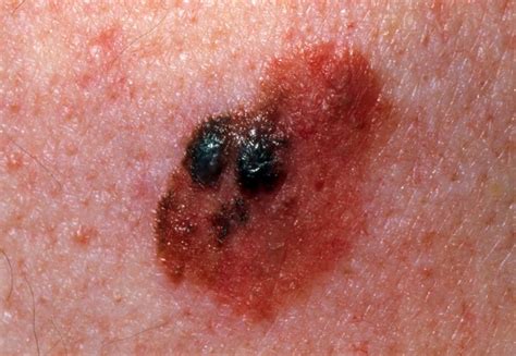 Photo Gallery of Skin Cancer by Type