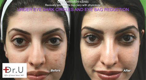 Video - Dark Circles and Eye Bags: Non-Surgical Eye Bag Reduction