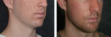Male Chin Augmentation | Best Male Chin Implants
