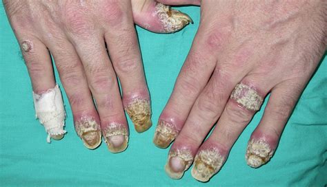 Acrodermatitis continua of Hallopeau and Koebner’s Phenomenon | Actas Dermo-Sifiliográficas