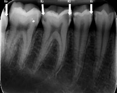 Tooth Cavity Xray