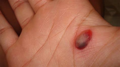 Blood Blister vs. Melanoma: How to Tell the Difference