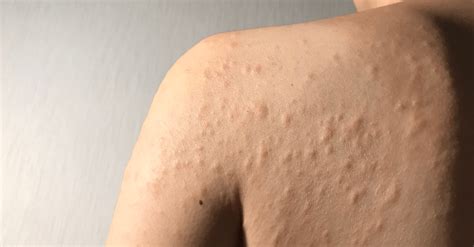 Allergic Reaction Grass Allergy Rash Pictures : Browse 71 food allergy rash stock photos and ...