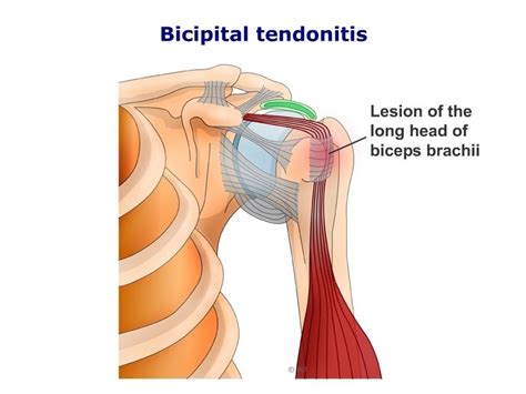 SAMARPAN PHYSIOTHERAPY FITNESS & REHAB. CLINIC: Bicipital Tendinitis And Physiotherapy Treatment ...