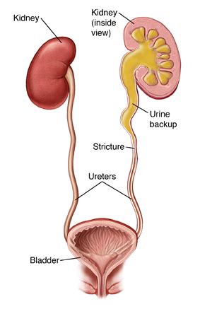 Cirugía de estenosis ureteral (ureteroplastia) | Saint Luke's Health ...