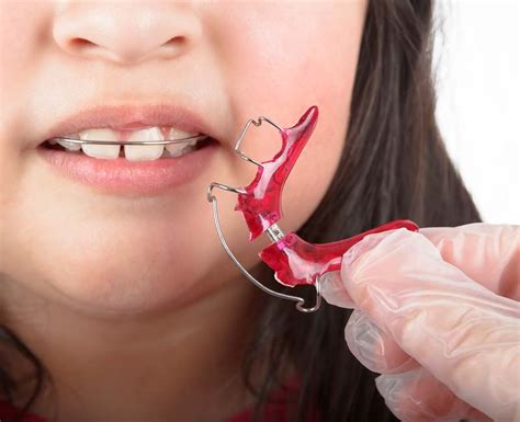 Benefits of Using a Removable Retainer - Vondran Orthodontics