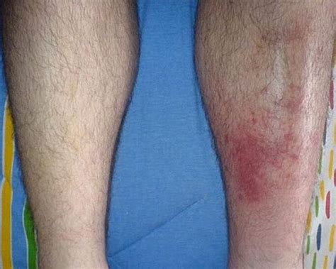 Cellulitis Symptoms In Legs