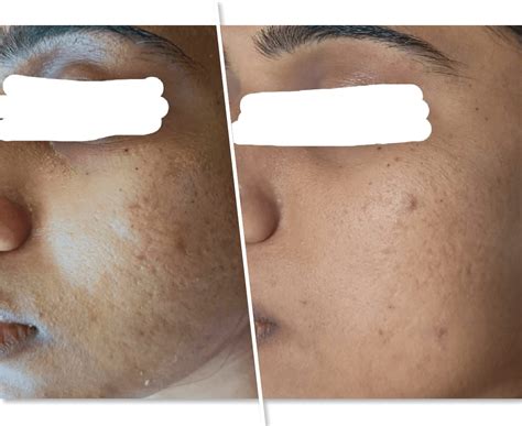 Natural Acne Treatment, Scar Removal in Bangalore, Hyderabad