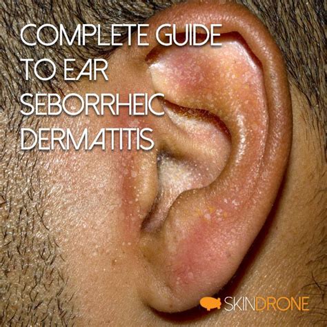 Seborrheic Eczema In Ear