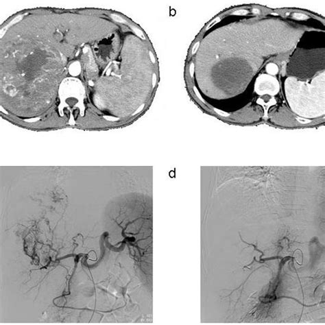 (PDF) Chemoembolization of liver cancer with drug-loading microsphere 50-100μm