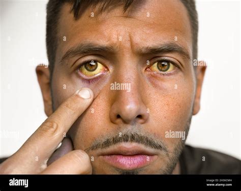 Liver disease yellow eyes skin hi-res stock photography and images - Alamy