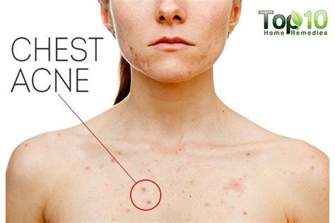 Home Remedies to Get Rid of Chest Acne | Top 10 Home Remedies