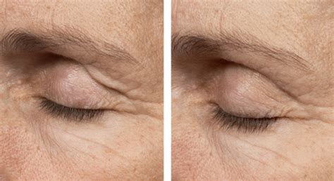 Thermage Treatments for the Eye Area - Dr. Michele Green M.D.