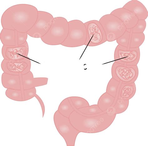 Ulcerative Colitis Intestine Disease Problem Gut Intestinal Vector ...