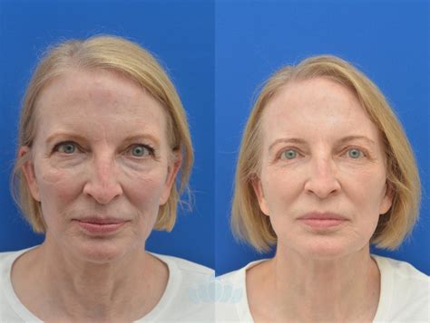 Eyelid Surgery (Blepharoplasty) for Charlotte & Concord, NC – Dilworth Facial Plastic Surgery