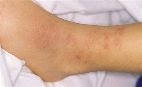 Pictures Of Vasculitis On Skin