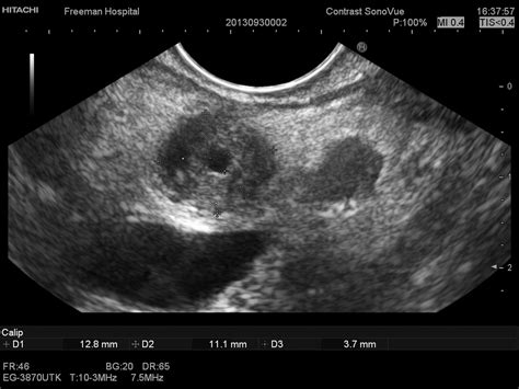 Biliary strictures: endoscopic assessment and management | Frontline ...