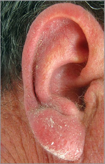 Demodectic Frost of the Ear | Dermatology | JAMA Dermatology | JAMA Network