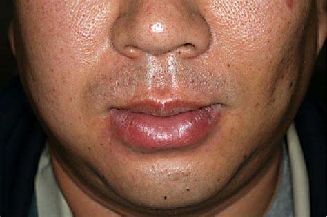 Figure 2 from Improvement of Cheilitis granulomatosa after Dental Treatment | Semantic Scholar