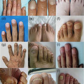 (PDF) Recognizing skin conditions in patients with cirrhosis: a narrative review