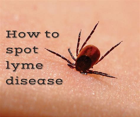 Lyme Disease Tick Bite Rash