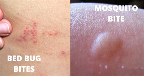 Bed Bug Vs Mosquito Bites In 7 Points Explained! | Y-L-P-C