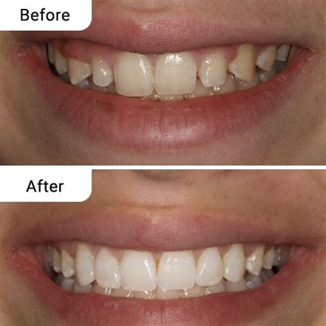 Smile Teeth Before & After Dental Treatment - Ivory Dental Clinic