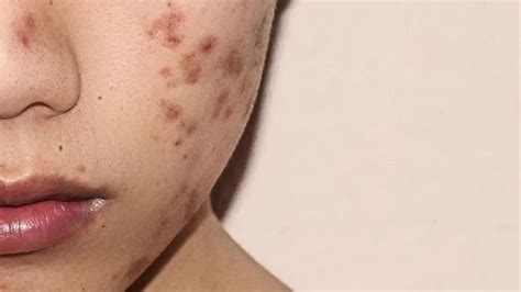 PCOS Acne Explained & How To Treat It Naturally - Holistic Nerd