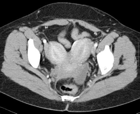 Bicornuate Uterus - radRounds Radiology Network