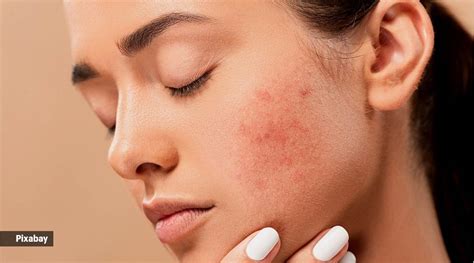 Skincare alert: Tips to quickly treat a pimple ahead of an important ...