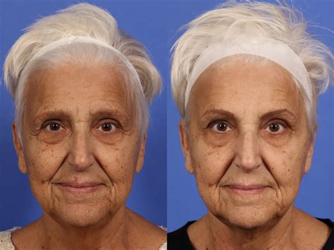 Botox Before and After Pictures | W Cosmetic Surgery