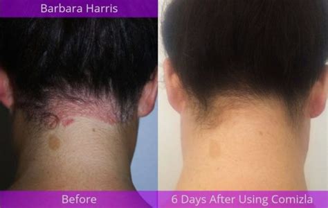 Comizla Psoriasis Cream – Stem Cell Therapy For Psoriasis